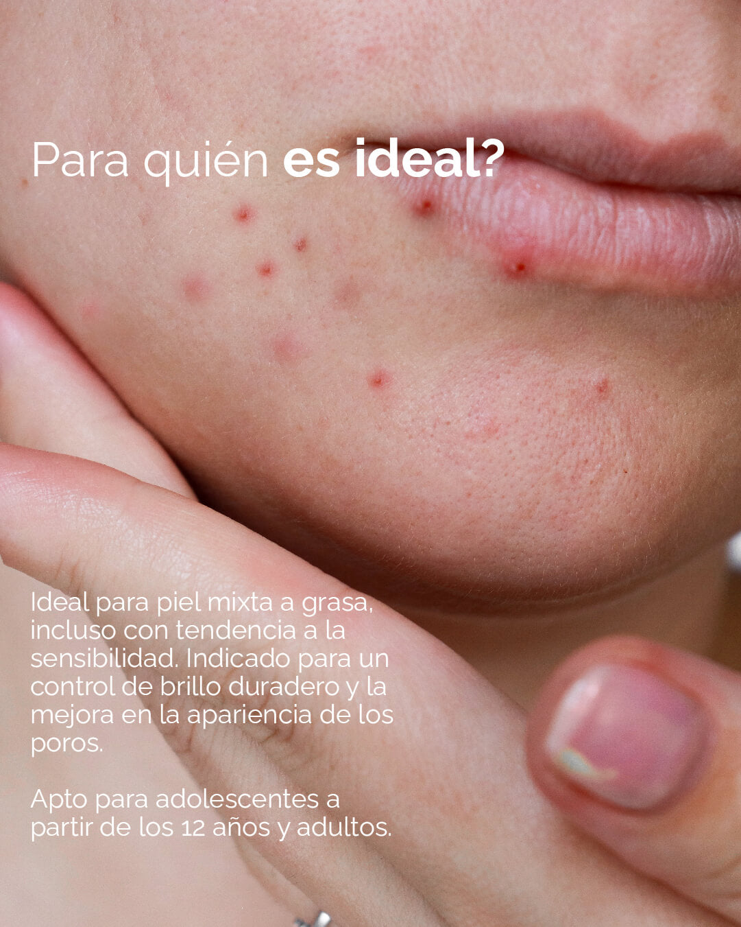 Matte: Crema Matificante Anti-Acné