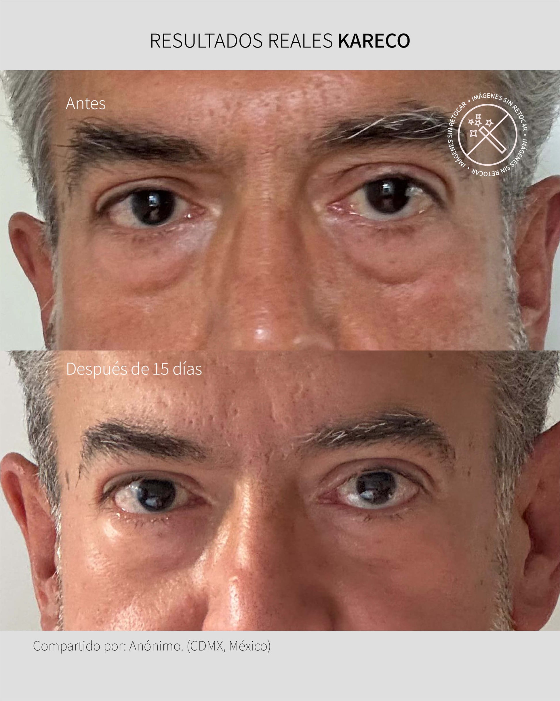 Eye Lift: Crema Humectante para Párpados - KareCo Derm