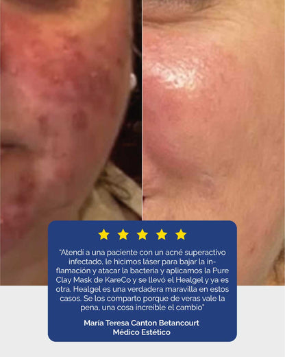 Healgel Restorative: Gel Hidratante Facial - KareCo Derm