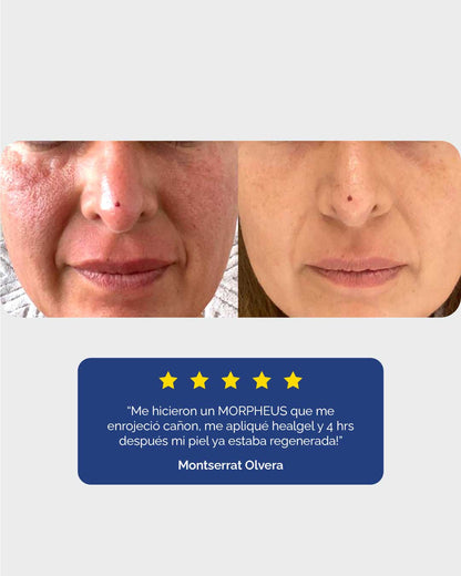 Healgel Restorative: Gel Hidratante Facial - KareCo Derm