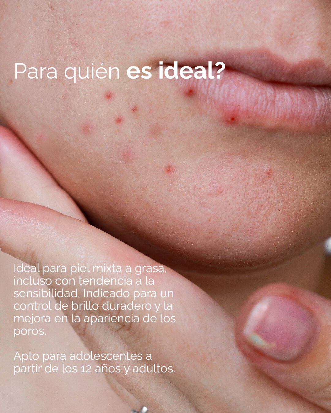 Matte: Crema Matificante Anti - Acné - KareCo Derm